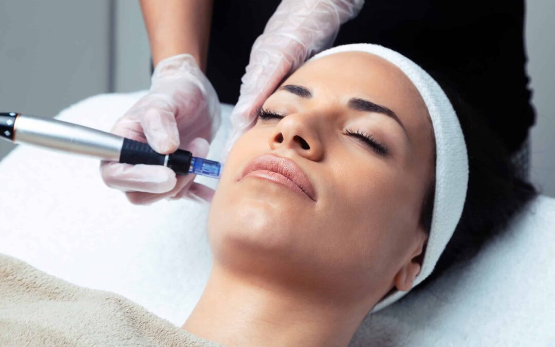 Dermapen en Málaga: microneedling facial en EDM Centro Estético